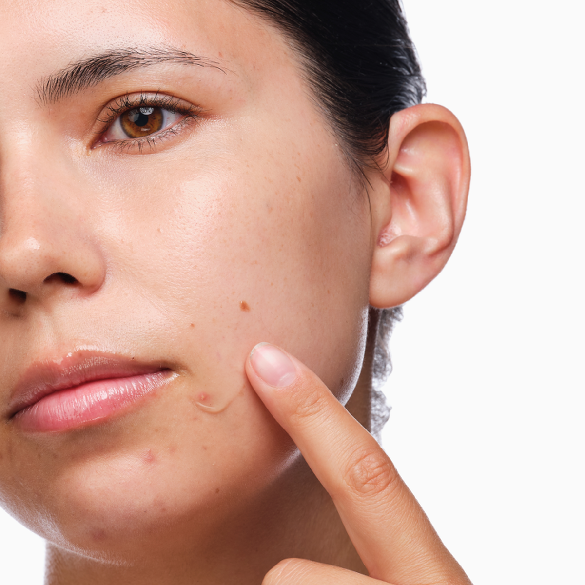 the-acne-set-m2 rdn-the-acne-set-application.png