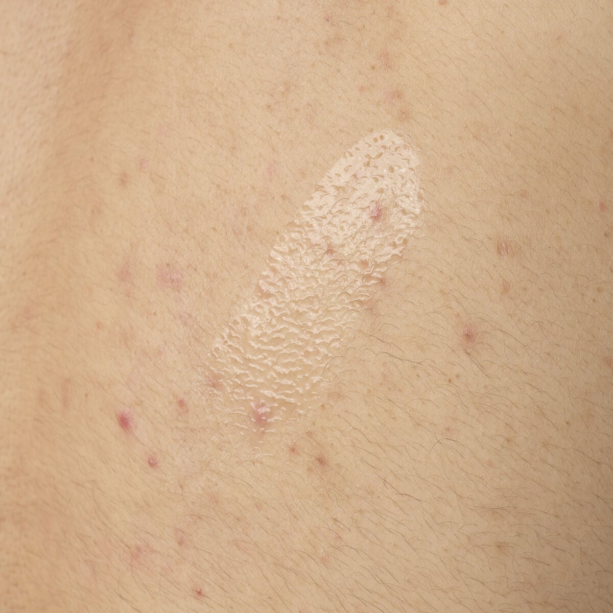 salicylic-acid-0-5-body-serum-h0 ORD-salicylic-acid-05-body-240ml-application.jpg