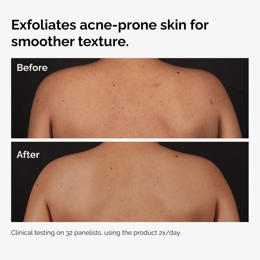 the-body-care-collection-r2 ord-salicylic-acid-body-serum-before-after-graphic-NA.jpg